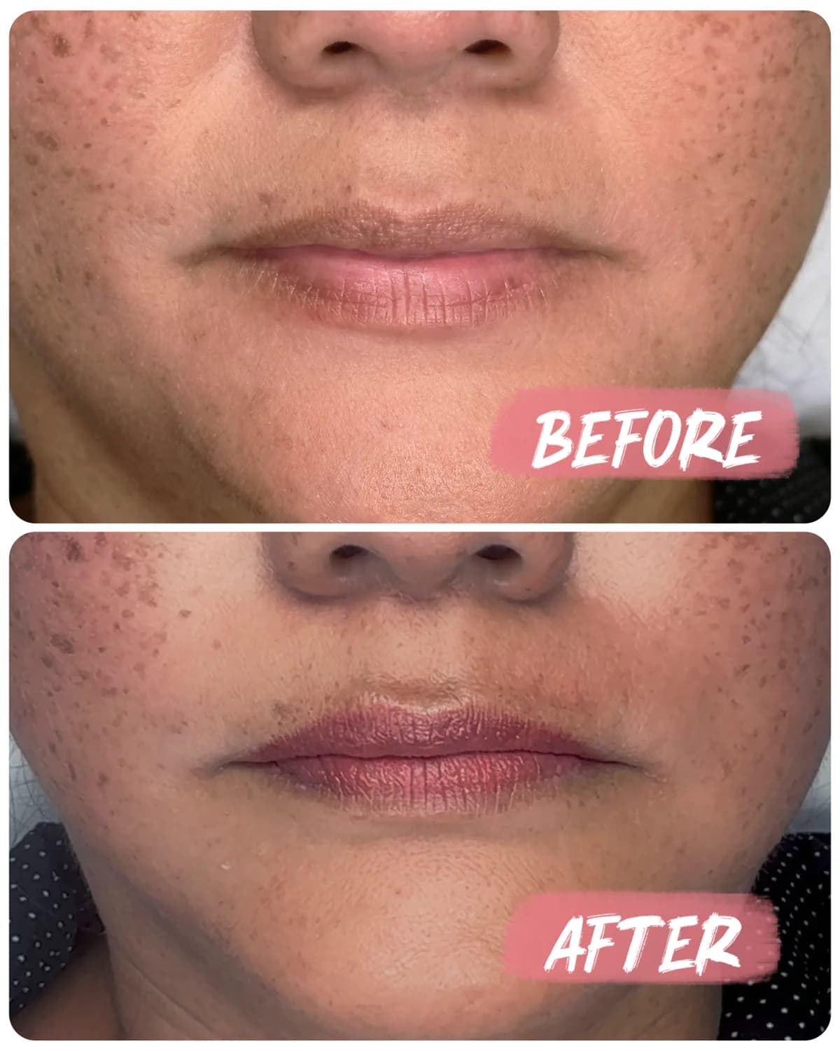 Before-and-after close-up of lips, showing a deeper mauve color and more defined outline in the after image.