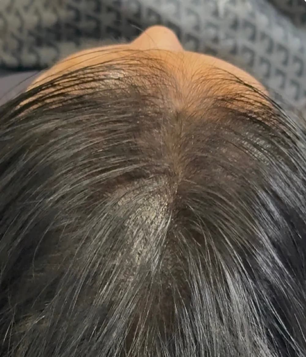 Close-up of dark hair and scalp after Cindy Keyes’s first scalp micropigmentation session.