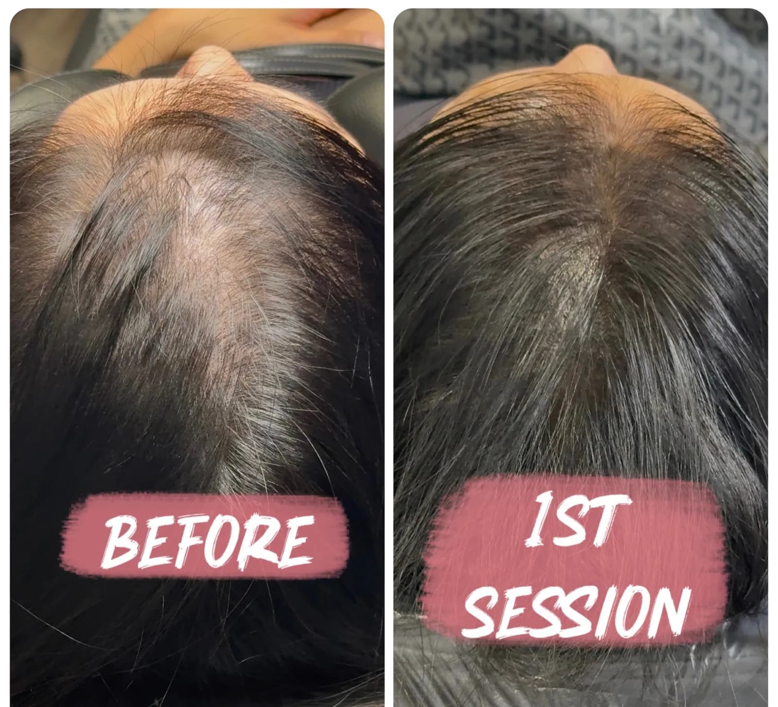 Side-by-side view before scalp micropigmentation and after the first session, showing reduced contrast between the scalp and dark hair.